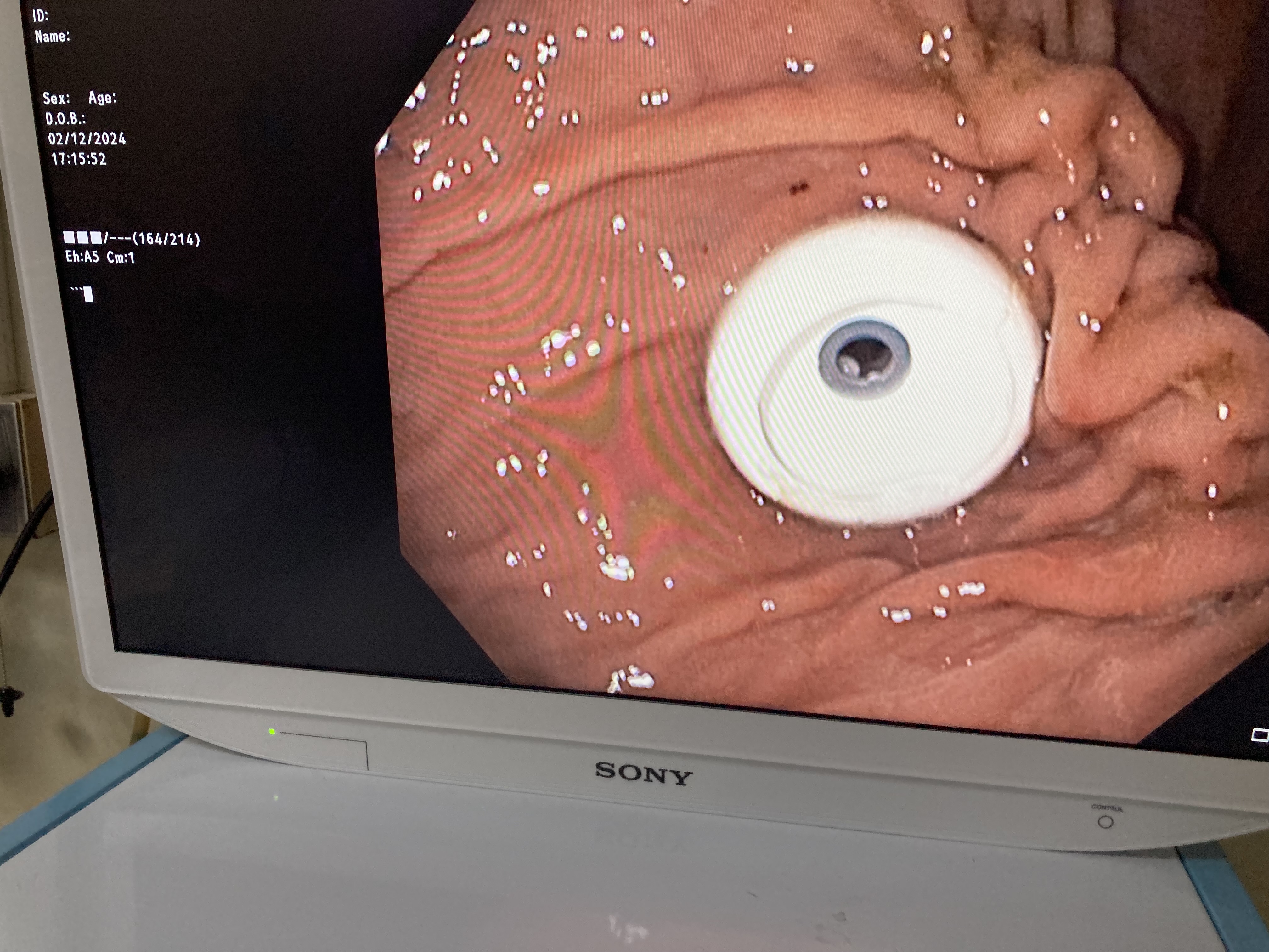 Mở thông dạ dày qua da (percutaneous endoscopic...
Mở thông dạ dày qua da (percutaneous endoscopic...