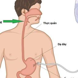 Bộ thay thế mở thông dạ dày ZKSK