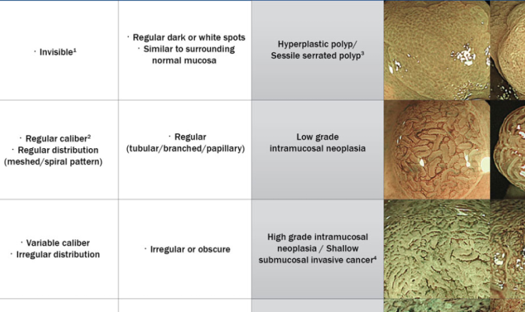   
          Đánh giá polyp đại trực tràng bằng phân loại JNET
