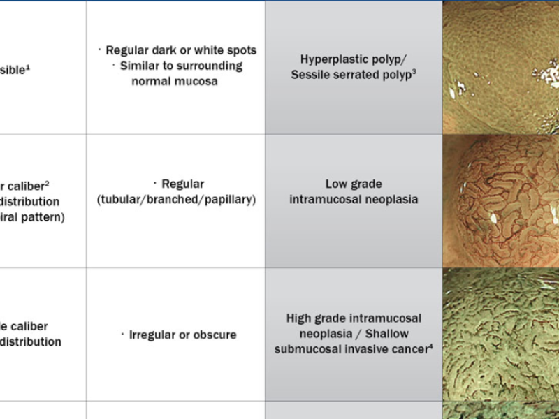   
          Đánh giá polyp đại trực tràng bằng phân loại JNET