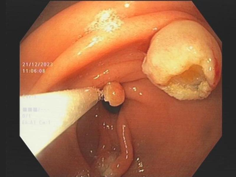   
          Tìm hiểu về kỹ thuật EMR trong cắt polyp ống tiêu hóa