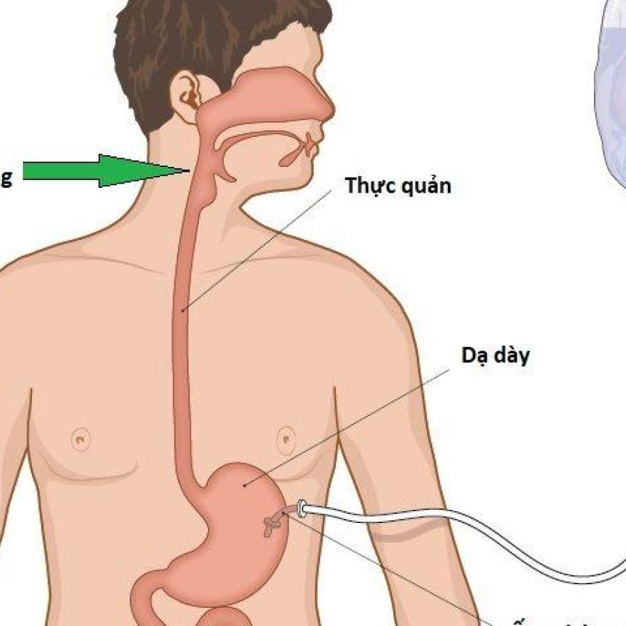 Bộ thay thế mở thông dạ dày ZKSK